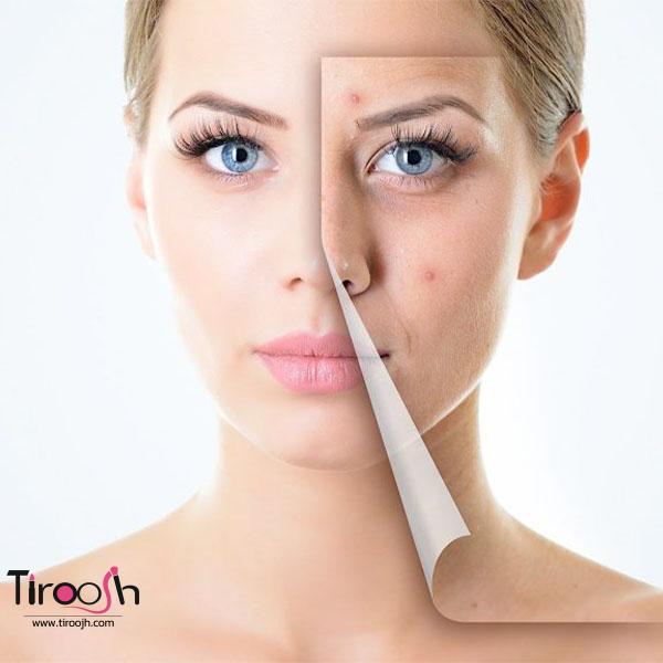 از بین بردن جای جوش
