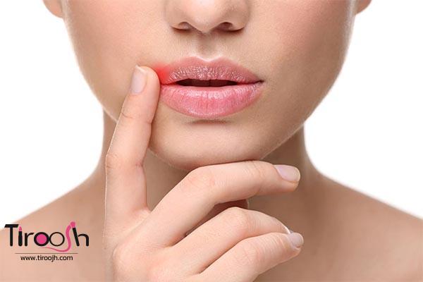 سریعترین راه برای از بین بردن تبخال
